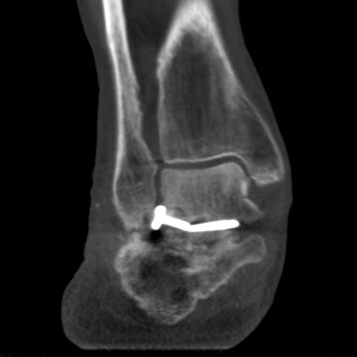 Case 1 AP and Oblique XRays